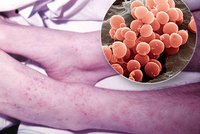 Díky covidu máme méně meningokoka. Počet případů s vážnou infekcí klesl o polovinu