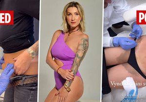 Dominika Mesarošová dala srovnání před a po liposukci břicha.