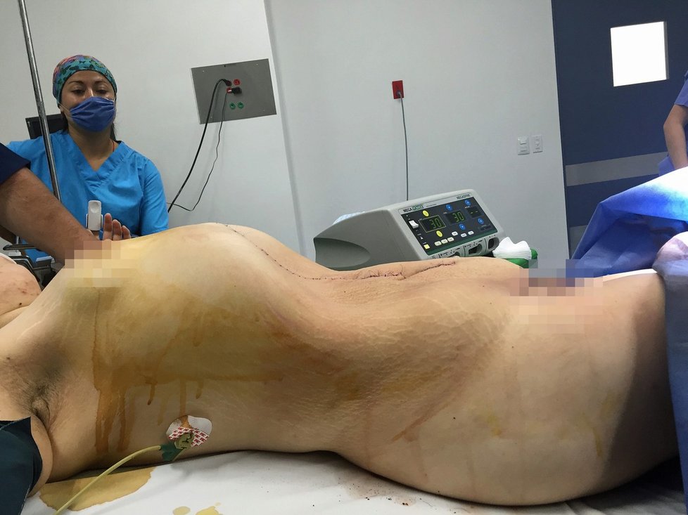 Chirurg vyoperoval ženě cystu vážící 31,75 kg!