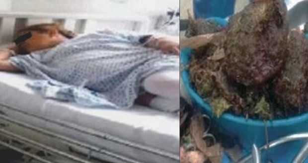 »Těhotná« žena si stěžovala na bolesti: Z břicha jí vytáhli kilo marihuany!