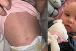 Vyrážka na bříšku, horečka a apatie. Malá Mia (7 měsíců) ze Staré Bělé skončila s postcovidovým syndromem na ARO fakultní nemocnice v Ostravě.