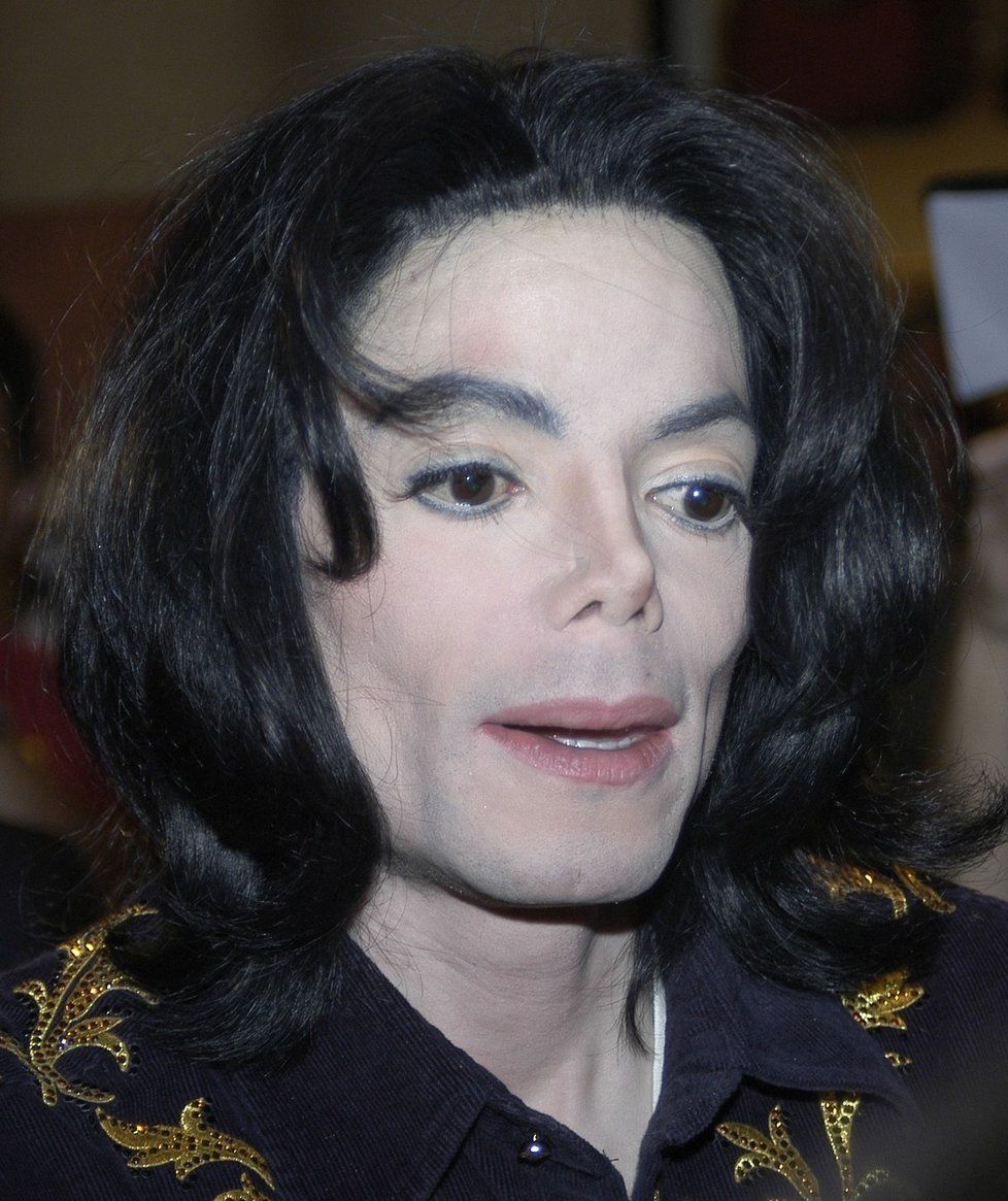 Nemoc vitiligo měl údajně i slavný Michael Jackson
