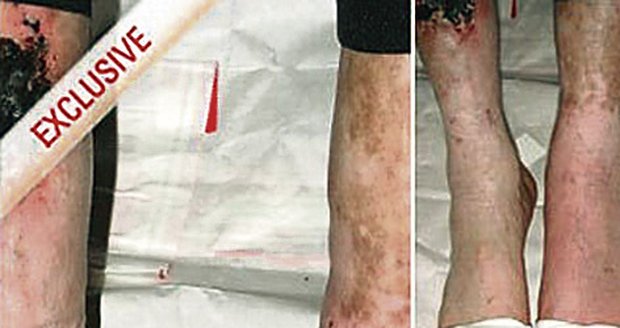 Michael Jackson: Tohle jsou jeho nohy zdevastované injekcemi a záněty