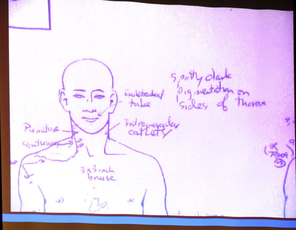 Nákres ukazuje, kde měl Jackson po těle vpichy, modřiny a zranění.