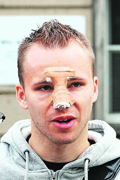 Michal Kadlec dostal pořádnou nakládačku. Po zákeřném útoku měl zlomený nos.