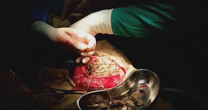 V žaludcích lidí trpícího touto nemocí se dá najít kde co