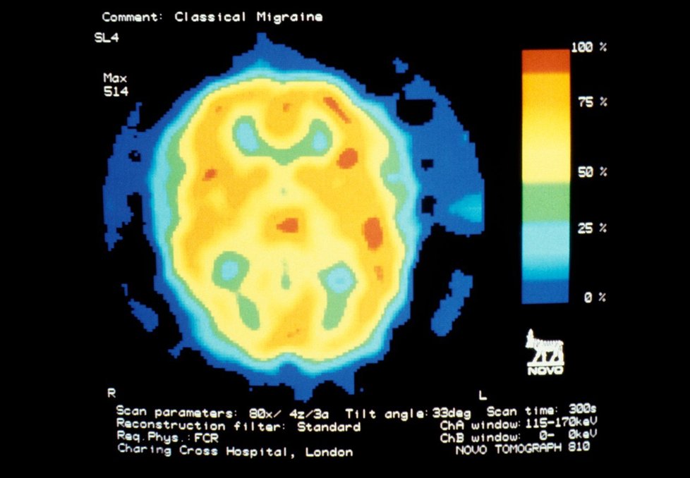 Mozek při záchvatu migrény