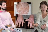 Miladu (53) málem upálil kriminálník: Živořím, stát mi neuznal invalidní důchod!