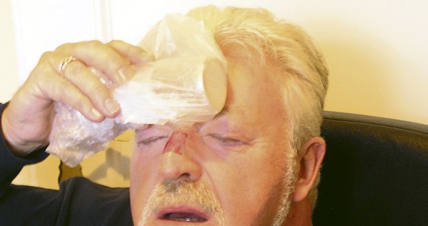 Milan Drobný si přeražením nosu způsobil slabší otřes mozku