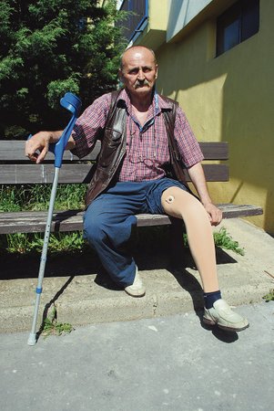 Miloš Kádner (60) viní nemocnici ze zbytečné amputace své nohy. Požaduje za to 25 milionů korun.