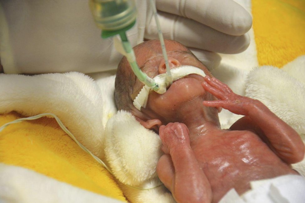 Lékaři v Podolí zachránili holčičku, která při porodu vážila 322 gramů