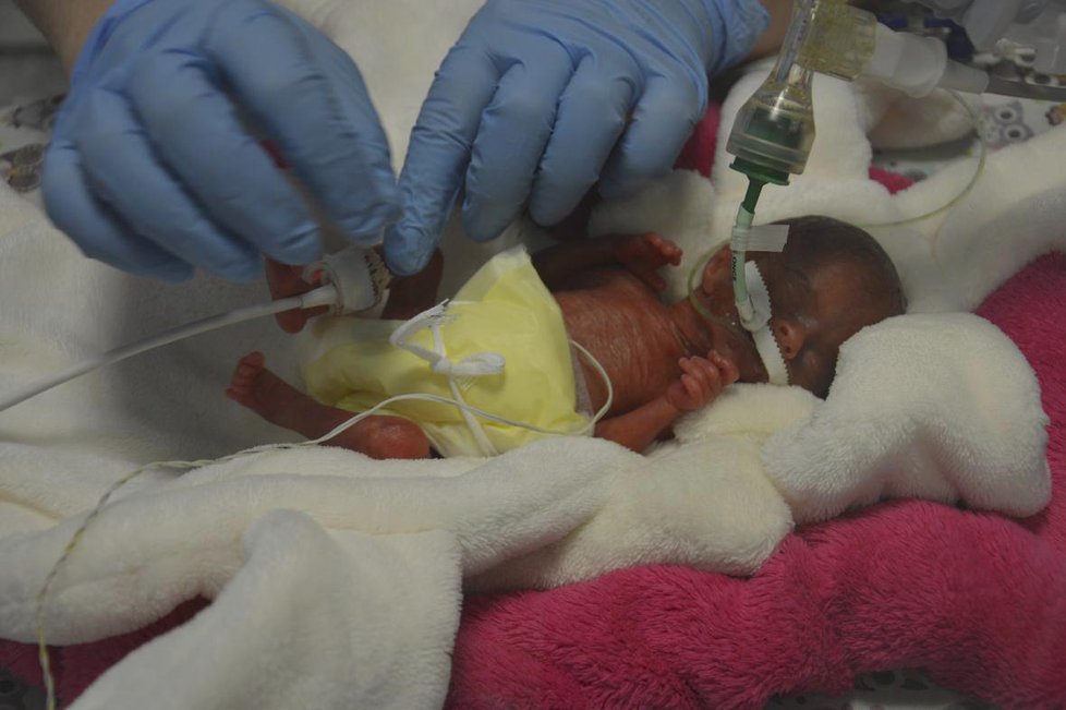 Lékaři v Podolí zachránili holčičku, která při porodu vážila 322 gramů