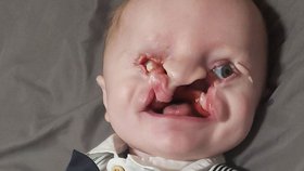 Chlapeček se narodil s vážným postižením: „Měla jsi ho potratit,“ píší lidé jeho mamince