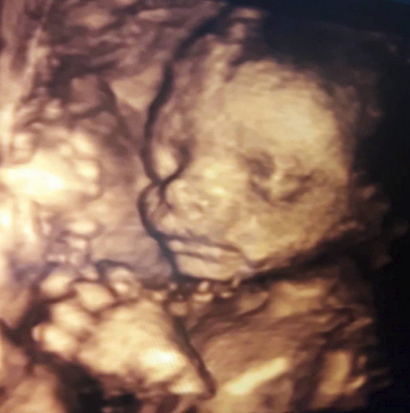 Miroslav Etzler ukázal ultrazvuk miminka