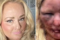 Takhle vypadá tvář oběti po brutálním znásilnění: Útočník pejskařce (44) vyrazil zuby, zlomil nos a čelist