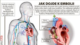 Jak dojde k embolii.