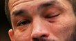 Bolestivé zranění oka Machmuda Muradova v UFC