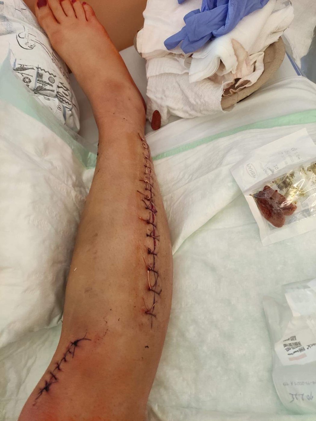 Noha zápasnice Veroniky Zajícové po náročné operaci