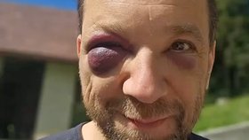 Modřina senátora za Ostrava-město Ondřeje Šimetku.