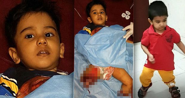 Malý Mohammed přišel při vlakové nehodě o obě nohy. Lékaři mu je ale přišili a chlapec už se naučil znovu chodit.