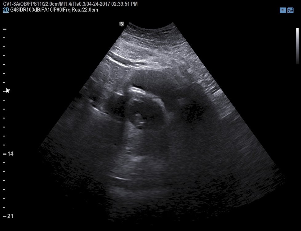 Ultrazvuk miminka.