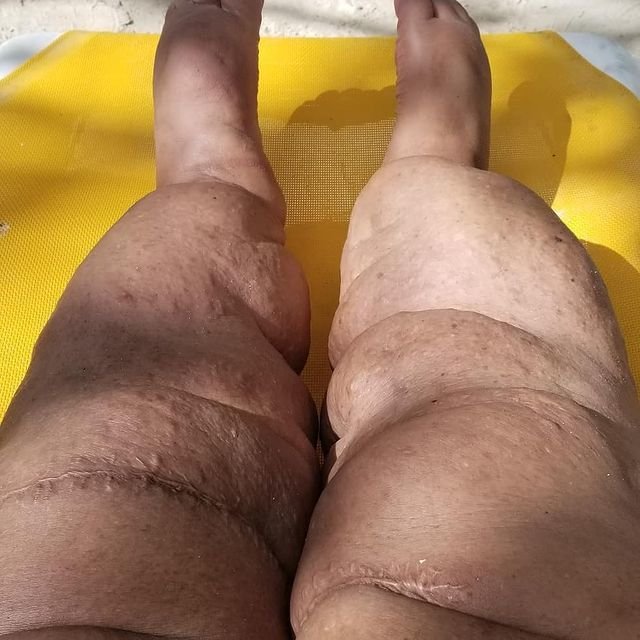 Monique Samuelsová (35) z americké Atlanty začala mít problémy s nohama, když jí bylo pouhých 12 let.