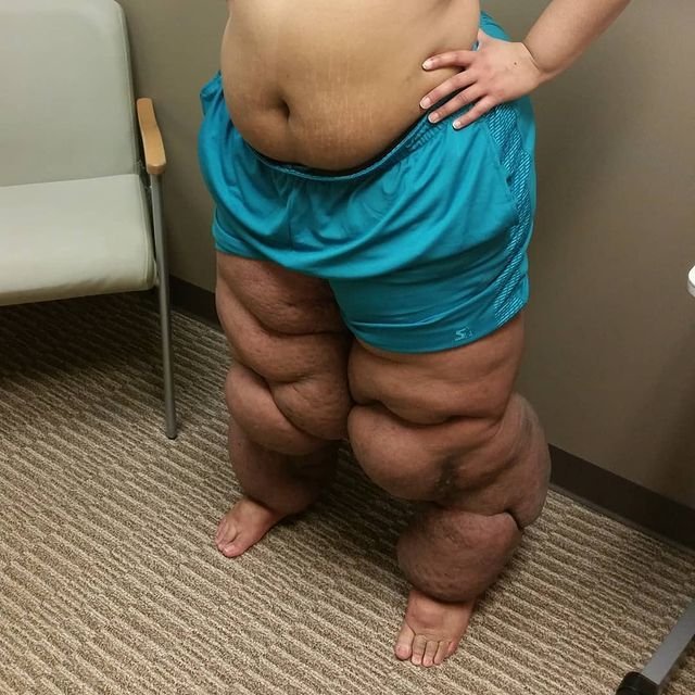 Monique Samuelsová (35) z americké Atlanty začala mít problémy s nohama, když jí bylo pouhých 12 let.