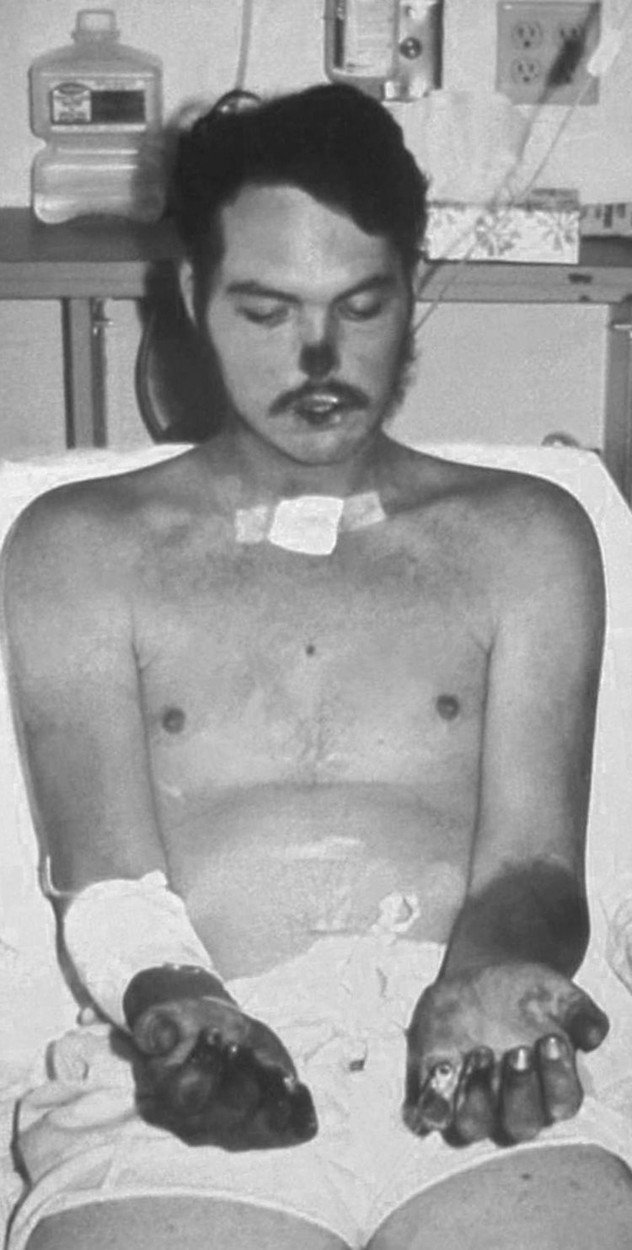 Muž nakažený morem, který způsobil gangrénu na rukou a nose