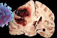 Mozková mrtvice i úzkosti: Po prodělání covidu hrozí neurologické či psychické obtíže