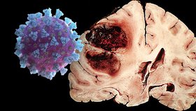 Po prodělání covidu hrozí neurologické a psychické potíže