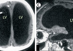 Státní úředník žil plnohodnotný život bez mozku 44 let: A nikdo si toho nevšiml!