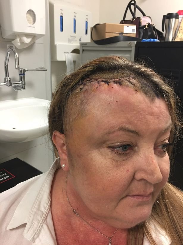 Po náročné operaci jí v hlavě zbyla kovová destička a 20 svorek