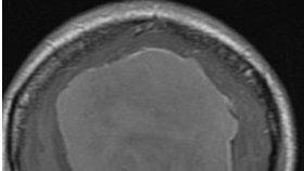 Na snímku je vidět obří nádor (světle šedý), který měla mladá žena v čelním laloku. Lékaři na něj přišli poté, co byla žena půl roku v psychiatrické léčebně a následně je napadlo jí udělat rezonanci