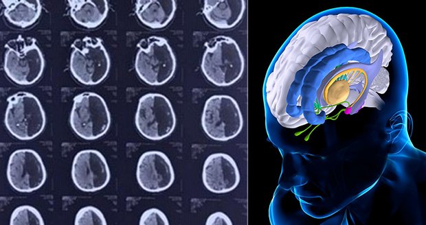 Bývalý voják šokoval lékaře: Žije s půlkou mozku!