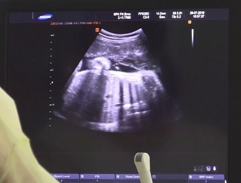 Ultrazvukový snímek miminka.
