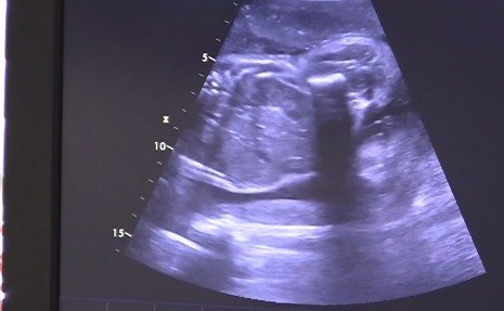 Ultrazvukový snímek miminka.