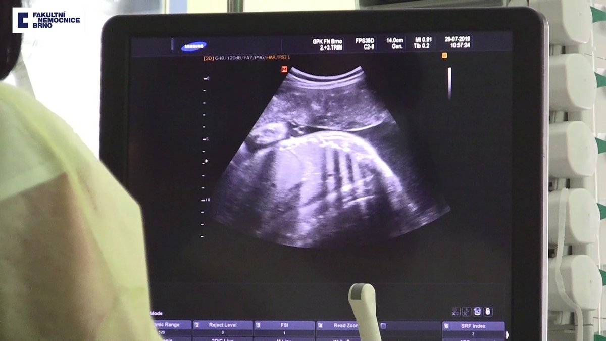 Ultrazvukové snímky Elišky. Prospívala výborně.