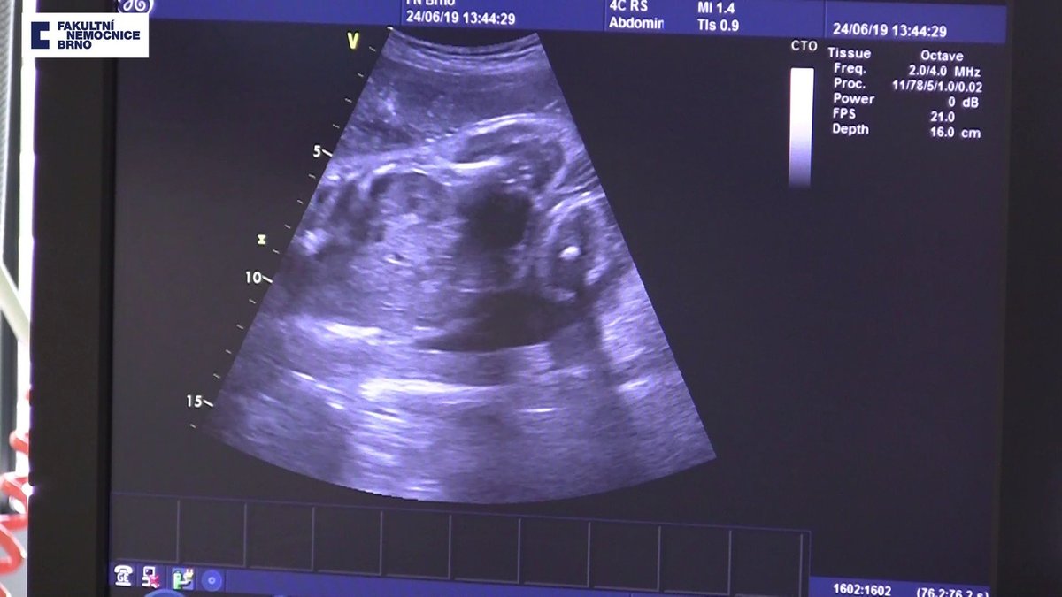 Ultrazvukové snímky Elišky. Prospívala výborně.