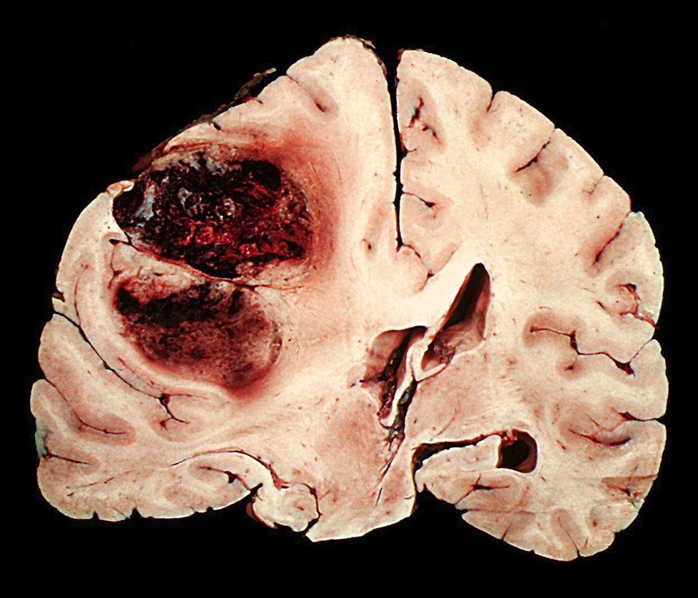 Mozek zasažený cévní mozkovou příhodou