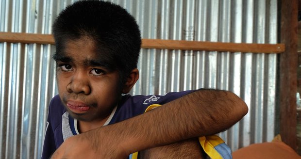 Chlapec (13) vypadá jako vlkodlak, v Indonésii ho uctívají jako boha
