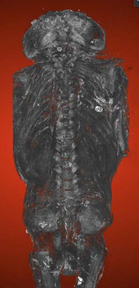 „Sokolí mumie“ nepatří dravému ptákovi, ale těžce postiženému lidskému plodu