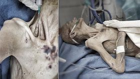 Lékaře vyděsila živoucí mumie: Zbídačenou ženu do nemocnice přivezl syn!