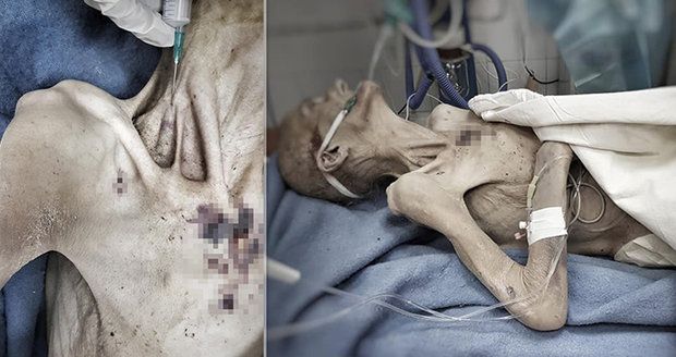 Lékaře vyděsila živoucí mumie: Zbídačenou ženu do nemocnice přivezl syn!
