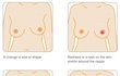 Jaké jsou symptomy rakoviny prsu?