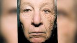 Slunce zdeformovalo řidiči náklaďáku levou stranu tváře: Tohle mu udělaly paprsky během 28 let