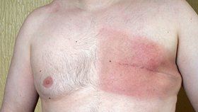Karel (72) si našel bulku v prsu: Muži si riziko rakoviny často nepřipouští