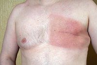 Karel (72) si našel bulku v prsu: Muži si riziko rakoviny často nepřipouští