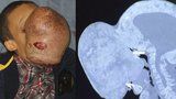 Chlapci (†14) odoperovali obří nádor z obličeje: Zemřel na pooperační komplikace