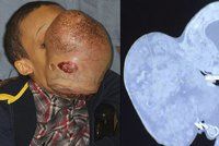 Chlapci (†14) odoperovali obří nádor z obličeje: Zemřel na pooperační komplikace
