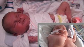 Lékaři na Floridě odoperovali dvouměsíční holčičce skoro kilogram vážící nádor na krku